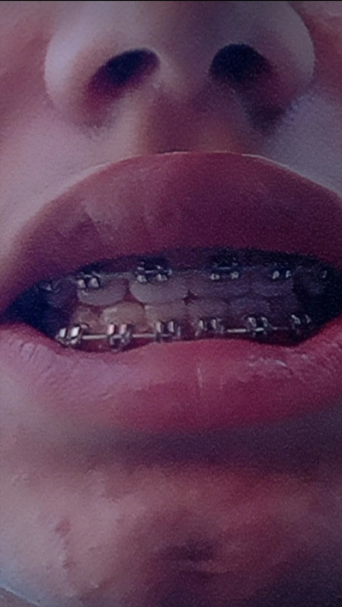 bracesfetish onlyfans leaked picture 2